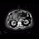 Retroperitoneal hematoma, active bleeding, revision, drain, edema of small bowel, fat stripe: CT - Computed tomography
